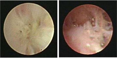 Low Bacterial Co-infection Invalidates the Early Use of Non-anti-Mycoplasma pneumoniae Antibiotics in Pediatric Refractory Mycoplasma pneumoniae Pneumonia Patients